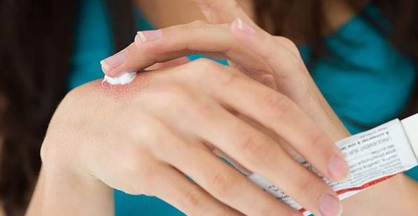 Các kem bôi ngoài da này có corticoid không?